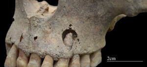 Photograph of a skeletal jaw from the front-left side, showing the tops of teeth below, a hole in the bone revealing the root of a tooth, and the bottom of the nasal opening at top.